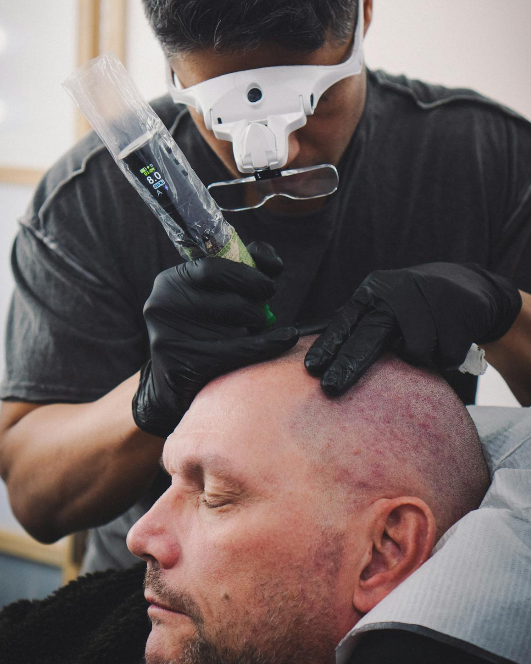 Scalp Micropigmentation